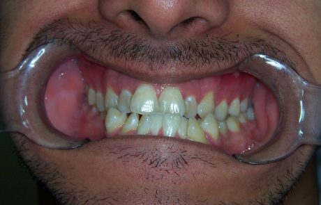 יישור שיניים למבוגרים: גשר בלתי נראה 
